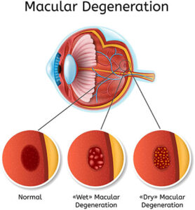 Macular Degeneration