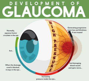 Glaucoma